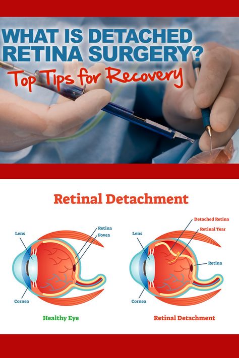 Detached Retina Recovery, Retina Detachment, Retina Surgery, Eye Retina, Eye Medicine, To Improve Eyesight, Eye Clinic, When To Plant Vegetables, Laser Eye Surgery