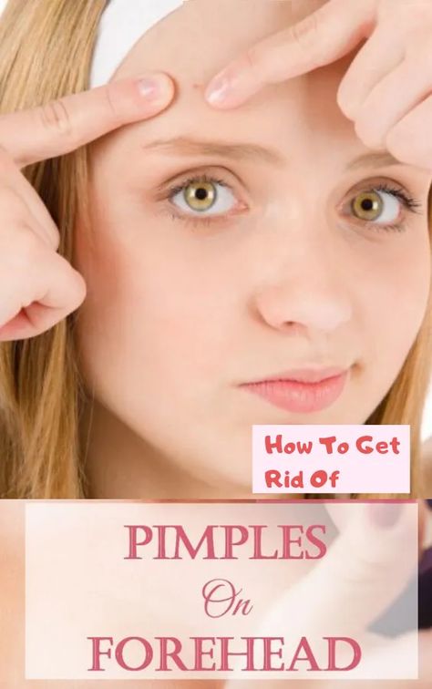 How To Get Rid Of Pimples On Forehead - EverydayHealth - Medium Pimple Home Remedies, Get Rid Of Forehead Acne, Pimples On Forehead, Get Rid Of Pimples, Rid Of Pimples, Forehead Acne, Pimples Overnight, Prevent Pimples, How To Get Rid Of Pimples