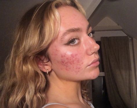 Pretty People With Acne, Girls With Acne, Acne Appreciation, Strawberry Freckles, Acne Is Beautiful, Acne Positive, Acne Is Normal, Acne Pictures, Girl With Acne