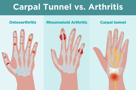 Arthritic Hand Pain Relief, Carpoltunal Relief Hands, Carpel Tunnel Symptoms, Carpultunal Wrist Relief, Arthritic Hands Natural Remedies, Carpal Tunnel Remedies, Carpal Tunnel Symptoms, Carpal Tunnel Exercises, Hand Problems