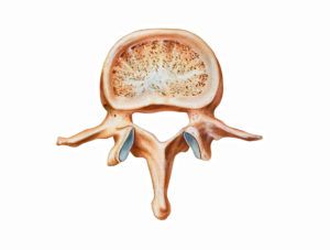 Spondylolisthesis is a spinal condition in which one vertebra slips forward over the vertebra below.  Degenerative spondylolisthesis, usually occurs in the lumbar spine, especially at L4-L5.  It is the result of degenerative changes in the vertebral structure that cause the joints between the vertebrae to slip forward.  This type of spondylolisthesis is most common among […] Brain And Spine, Spine Care, Hamstring Muscles, Spinal Column, Lumbar Spine, Tight Hamstrings, Muscle Weakness, Ct Scan, Muscle Spasms