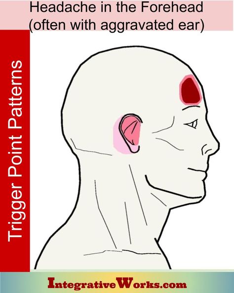 Headache in the Forehead - Integrative Works Forehead Headache, Headache Meaning, Cervicogenic Headache, Therapist Notes, Sternocleidomastoid Muscle, Forward Head Posture Exercises, Relieve Neck Pain, Neck Ache, Neck And Shoulder Muscles