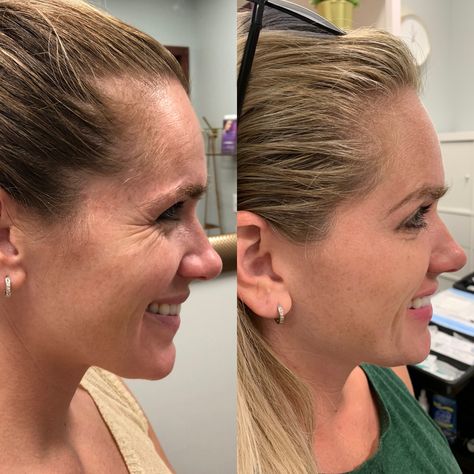 Botox For Crows Feet Before And After, Crows Feet Botox Before After, Crows Feet Botox Before After Eyes, Botox Crows Feet Eye, After Botox Care, Botox Training For Nurses, Botox Astetic, Preventative Botox Before And After, Botox Before And After