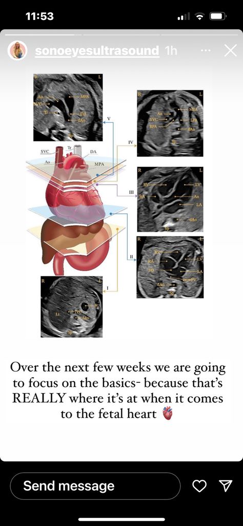 Diagnostic Sonography, Cardiac Ultrasound, Echo Sonography, Understanding Ultrasound Physics, Obstetric Ultrasound, Ultrasound Fetal Heart Views, Cardiac Sonography, Sonography Student, Ultrasound Sonography