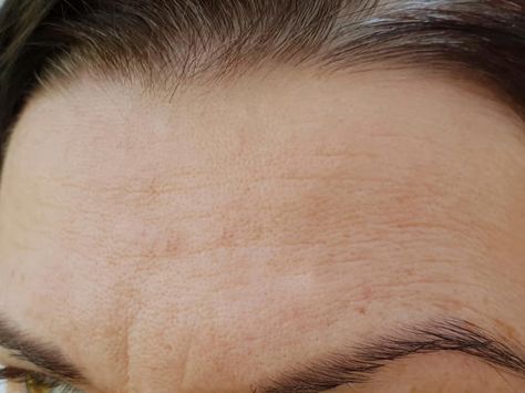 Are they forehead wrinkles or dehydration lines? Creases on your forehead can be signs of dehydrated skin rather than early wrinkles. Here's how to fix them with simple skincare products. Forehead Wrinkles Remedies, Remove Forehead Wrinkles, Get Rid Of Forehead Wrinkles, Facial Wrinkles, Forehead Wrinkles, Exfoliating Cleanser, Deep Wrinkles, Chemical Peel, Acne Marks