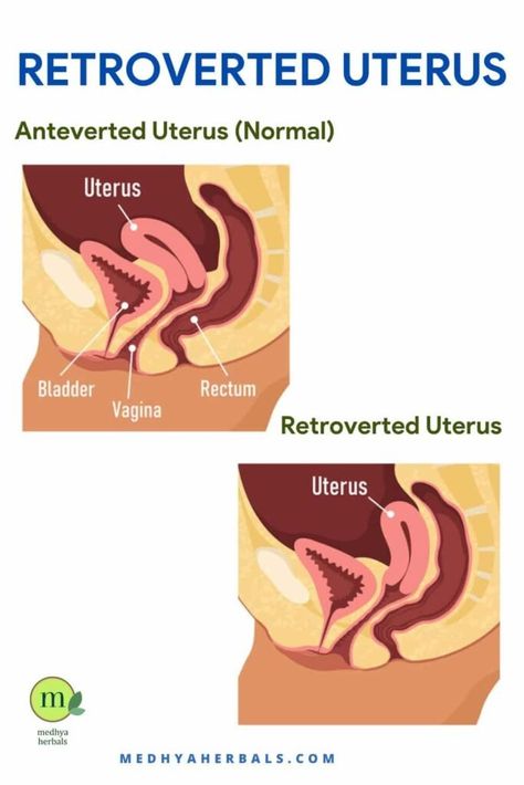 <p>An anteverted uterus, though it may sound complex, holds the key to understanding your reproductive health. If you’ve ever wondered, “Is an anteverted uterus good or bad?” or pondered the mysteries behind “anteverted uterus pregnancy bumps,” you’re in the right place. In this blog, we’ll decode the significance of an anteverted uterus, its potential impact […]</p> <p>The post <a rel="nofollow" href="https://medhyaherbals.com/anteverted-uterus... Polyps Uterus Remedies, Retroverted Uterus Exercise, Polyps Uterus, Tilted Uterus, Uterus Health, Retroverted Uterus, Bicornuate Uterus, Cramps During Pregnancy, Prolapsed Uterus