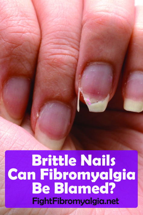 Brittle Nails: Can Fibromyalgia Be Blamed? - #blamed #brittle #fibromyalgia #nails #BiotinForHairLoss #HowToPreventBabyHairLoss #BiotinAndHairLoss #NaturalRemediesForHairLoss #BlackCoffeeForWeightLoss Hands Care, Nail Conditions, Broken Nails, Brittle Nails, Chronic Fatigue, Homemade Dog, Hand Care, Health Conditions, Migraine