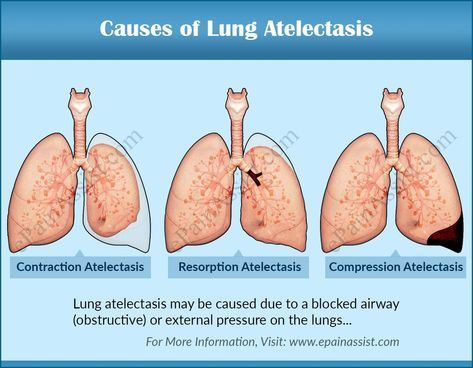 Lung atelectasis Pulmonary Nursing, Respiratory Therapy Student, Human Respiratory System, Medical Ultrasound, Psych Nurse, Med Surg Nursing, Nursing School Essential, Pulmonology, Respiratory Care