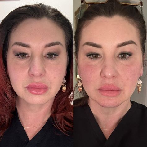 🚀 Game-Changer Alert: Chin & Cheek Filler Magic! 🧚‍♀️✨ Before: Fine lines & tired look 😕 After: Youthful glow & smooth skin 😍 Can you believe this is just 1.5 syringes of RHA 4? 💉 ✅ Reduced mouth wrinkles ✅ More defined chin ✅ Plumper cheeks ✅ Overall youthful boost The best part? Results last 15-18 months! 🎉 Ready for your glow-up? Drop a ‘✨’ below! #PickturePerfect #FillerMagic #BeforeAndAfter #AgelessBeauty #BedfordTX #SouthlakeTX #FortWorthTX #DallasTX #ArlingtonTX #BeautySecrets #c... Tired Look, Mouth Wrinkles, Cheek Fillers, Ageless Beauty, Beauty Secrets, Game Changer, Smooth Skin, Glow Up?, Wrinkles