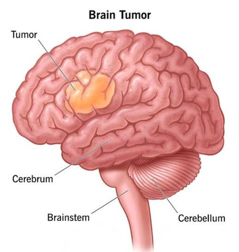 Educatrix: BRAIN 🧠_Tumor Glial Cells, Brain Tumour, Cushings Syndrome, Brain Tumors, Abnormal Cells, Pituitary Gland, Brain Tissue, Memory Problems, Nerve Cell