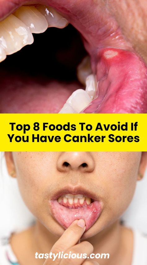 are bananas good for canker sores | is milk good for canker sores | foods to eat with canker sores on tongue | canker sore treatment | summer dinner recipes | healthy lunch ideas | dinner ideas | breakfast ideas | easy healthy dinner recipes Mouth Sore Remedy How To Get Rid, Canker Sore Remedy For Kids, Canker Sore Remedies, Sores In Mouth Remedies, Natural Canker Sore Remedies, Canker Sore Remedy Overnight, Natural Canker Sore Remedy, What Causes A Canker Sore, Canker Sore On Tongue