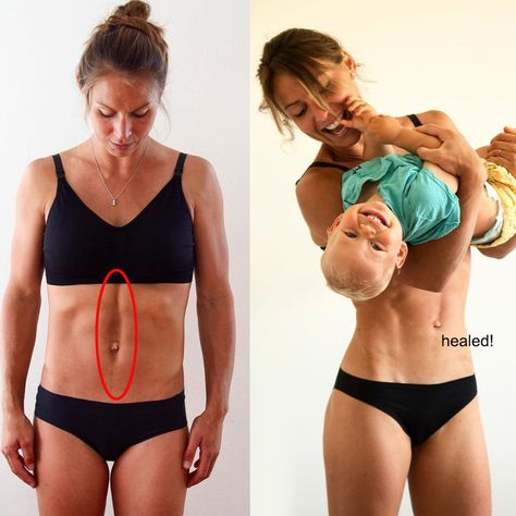 Ab Separation Exercises, Diastasis Recti Before After, Transverse Abdominal Exercises, Doula Resources, Diastasis Recti Repair, Diástase Abdominal, Post Pregnancy Belly, Healing Diastasis Recti, Gym Bunny