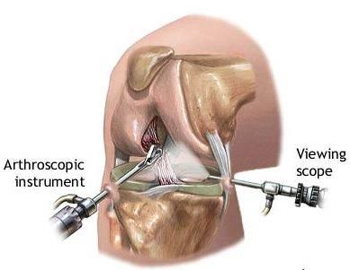 Arthroscopic Shoulder Surgery, Acl Surgery Recovery, Arthroscopic Knee Surgery, Acl Knee, Acl Surgery, Knee Pain Exercises, Ligament Tear, Shoulder Surgery, Platelet Rich Plasma