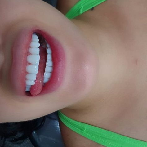 Keep Up With Nicole Zavala on Instagram: “My teeth are perfect !!! Thank you @drmariomontoya pearly whites love it came all the way to Colombia to get this done his work is truly…” Perfect Teeth Aesthetic, Nicole Zavala, Pearly White Teeth, Loose Teeth, Teeth Aesthetic, Pretty Teeth, Beautiful Teeth, Loose Tooth, Straight Teeth