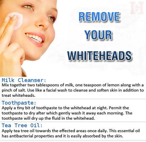 Chin Whiteheads, Chin Acne Remedies, Chin Breakouts, Chin Acne Causes, Whiteheads Remedy, Chin Acne, Blind Pimple, Get Rid Of Blackheads, Soften Skin