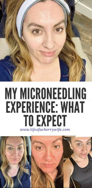 Microneedle Before And After, Skin Needling Before And After, What Is Microneedling, Post Microneedling Care, Microchanneling Before And After, Before And After Microneedling, Microneedling Before And After At Home, Radio Frequency Microneedling, Dr Pen Microneedling Before And After