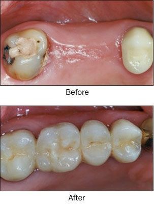 periodontal disease Tooth Bridge, Dental Room, Dental Bridge Cost, Lake Worth Florida, Maxillofacial Surgery, Dental Spa, Dental World, Dental Education, Dental Assisting