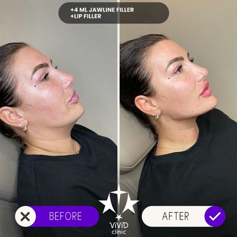 💉✨ Sculpt and define your face with Jawline Filler at Vivid Clinic! Check out this stunning Client Transformation—perfectly contoured, sharper jawline for a more defined and balanced appearance. 💎 ✅ Enhances facial definition ✅ Non-surgical with immediate results ✅ Long-lasting, natural-looking transformation 💬 Want to achieve a similar look? Book your free consultation today and take the first step toward a more sculpted you! 📍Located in Istanbul, Turkey 🌐 vividclinic.net 📞 🇺🇸 +90 545 742... Facial Definition, Sharper Jawline, Jawline Filler, Face Fillers, Lip Fillers, Look Book, Take The First Step, Istanbul Turkey, Free Consultation