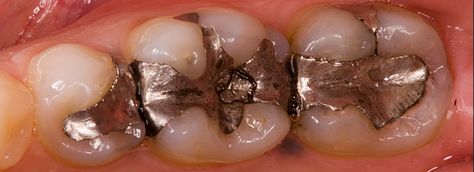 Cavity preparation of amalgam restoratios Prepared by : Maha Akram ￼ HISTORY ◦ •Amalgam was introduced to the United States in the1830s. ◦ •Initially, amalgam restorations were made by dentists filing silver coins and mixing the filings with mercury, creating a putty-like mass that was placed into the defective tooth. ◦ As knowledge increased and research intensified, major advancements in the formulation and use of amalgam occurred. ◦ • However, concerns about mercury toxicity we Amalgam Fillings, Cavity Filling, Tooth Filling, Dental Fillings, Flora Intestinal, Dental Practice, Tooth Decay, Autoimmune Disease, Dental Health