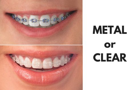 Clear Braces Vs Metal, Lingual Braces, Ceramic Braces, Braces Cost, Types Of Braces, Adult Braces, Cute Braces, Clear Braces, Braces Colors