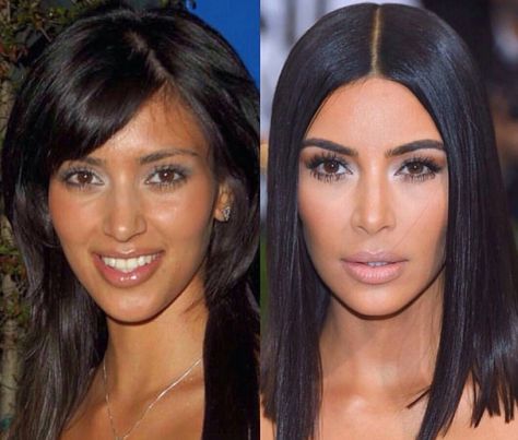 Kim Before And After, Aesthetic Procedures, Lace Front Black, Celebs Without Makeup, Plastic Surgery Gone Wrong, Body Makeover, Black Wigs, Facial Fillers, Nose Surgery