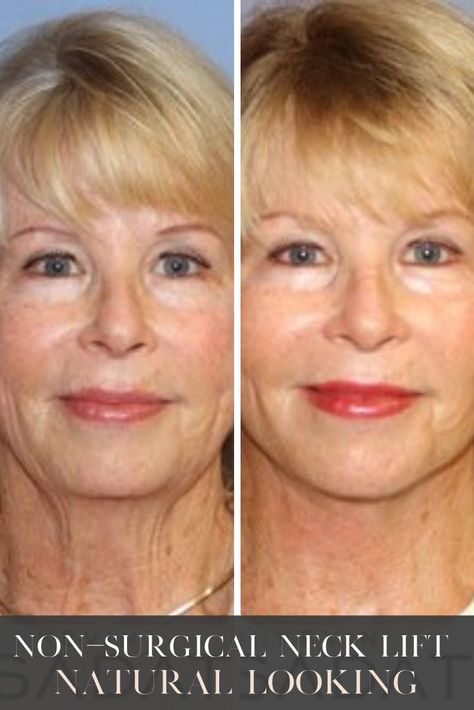 Lower Face And Neck Lift, General Anesthesia, Skin Improvement, Aloe Vera Face Mask, Neck Lift, Long Layered Haircuts, Face Facial, Stunning Makeup, Aging Gracefully