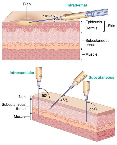 Needle Angles: Standard medication doses for adults are to be rounded to the nearest tenth (0.1) of a milliliter. The standard 3-mL syringe is calibrated in tenths of a milliliter. The nurse should not administer more than 3 mL per intramuscular or subcutaneous injection site; when a volume greater than 3 mL is required, a 5-mL syringe, calibrated in fifths, may be used. Medical Assisting, Certified Medical Assistant, Emt Paramedic, Fundamentals Of Nursing, Nursing School Studying, Nursing School Tips, Nursing School Notes, Phlebotomy, Medical Terminology