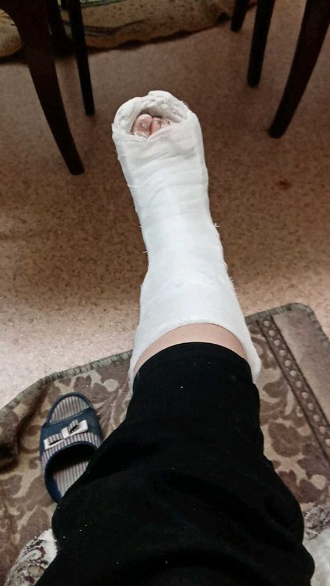 Broke Leg Snapchat, Asthetic Picture White And Black, Muslimah Photography, Broken Foot, Leg Cast, Snap Snapchat, Best Snapchat, Mehndi Designs Front Hand, Scammer Pictures