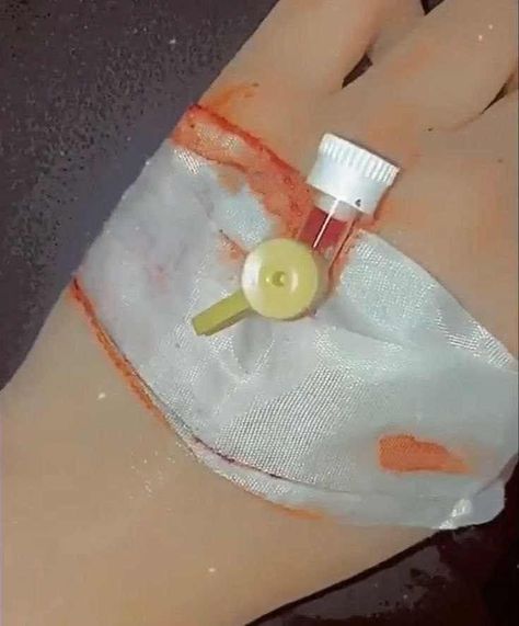 Munna Tripathi, Girl Hand With Drip In Hospital, Bandage On Hand Dpz, Injection Hand Pic, Hands With Drip In Hospital, Creative Snaps For Snapchat, Hospital Admit Hand Pics, Camera Tattoo, Drawing People Faces