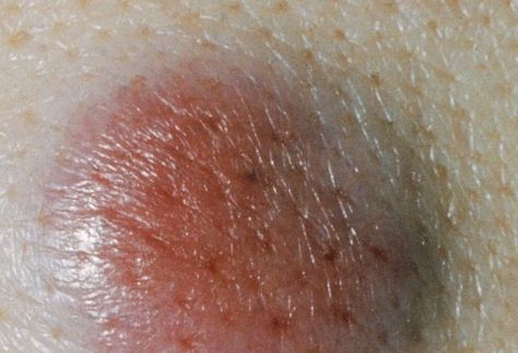 Merkel Cell Carcinoma Basel Cell Carcinoma Pictures, Basil Cell Carcinoma, Basal Cell, Squamous Cell, Types Of Skin, Types Of Cancers, Skin Repair, Health And Beauty Tips, Skin Cells