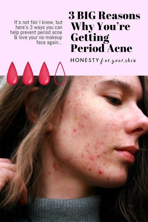 This is your ultimate guide to hormonal breakouts, period pimples and acne before your period. Plus how to get clear, calm, happy skin. Period Acne, Period Pimples, Chin Breakouts, Back Acne Remedies, Hormonal Breakouts, Forehead Acne, Prevent Pimples, Scar Removal Cream, Acne Help