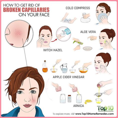 how to get rid of broken capillaries on face Broken Capillaries On Face, Blood Vessels On Face, Redness On Face, Top 10 Home Remedies, Natural Hair Mask, Beauty Tips For Face, Homemade Skin Care, Face Scrub, Wash Your Face