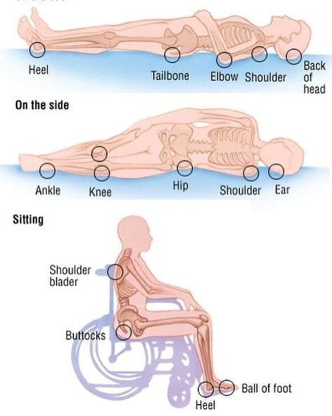 Bed Sores Prevention, Pressure Ulcers Nursing, Wound Care Nursing, Nclex Questions, Nursing Assessment, Bed Sores, Pressure Ulcer, Medical Surgical Nursing, Fundamentals Of Nursing