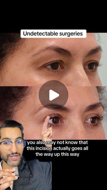 Prem Tripathi, MD on Instagram: "Everyone wants undetectable results, and we’re here for it. 

Upper eyelid surgery is truly transformative and will keep you looking like yourself, but just refreshed. 

Every surgeon uses a different technique, but I got you 😁

Ready for yours?
📆 direct online booking in bio 
📱925-272-9998

#drpremtripathi #facialplasticsurgery #alamoca" Eyelid Surgeries, Facial Plastic Surgery, Upper Eyelid, I Got You, Surgery, Like You, Beauty Hacks, Makeup, On Instagram