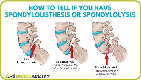 How to Tell If You Have Lumbar Spondylolisthesis or Spondylolysis in Your Lower Back Back Problems Lower, Pars Defect, Spinal Chord, Anatomy Spine, Spine Problems, Chronic Back Pain, Middle Back Pain, Spine Health, Back Pain Remedies