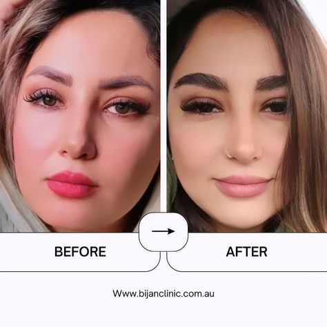 Achieve the perfect brow transformation at Bijan Hair and Eyebrow Transplant Clinic in Australia. Specialized eyebrow transplant for natural and fuller brows. ..... CONTACT INFO ■www.bijanclinic.com.au ��■Tel - 0291917491 ■ info@bijanclinic.com.au #EyebrowTransplant #BrowTransformation #HairClinic #sydney #bijanclinic #NaturalBrows #FullerBrows #AustraliaClinic #CosmeticSurgery #EyebrowGoals #EyebrowSpecialist #PermanentBrows #BeautyEnhancement #BrowGameStrong #بیوتی #زرع_الحواجب #عناية_بال... Good Eyebrows, Brow Transformation, Drawing Natural, Eyebrow Transplant, Girl Hacks, Eyebrow Trends, Perfect Brow, Eyebrow Hacks, Full Brows