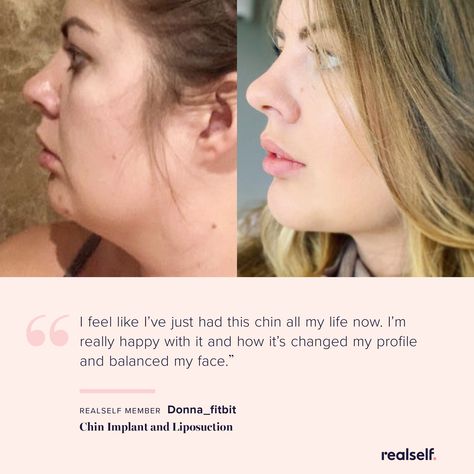 Chin enhancement surgery can enhance a recessed or weak chin, improve the appearance of a double chin, and improve the definition of the jawline. Chin Implants Before And After, Jawline Implants, Weak Chin Profile, Weak Jawline Women, Chin Implant Before And After, Recessed Chin, Weak Jawline, Overbite Correction, Double Chin Surgery