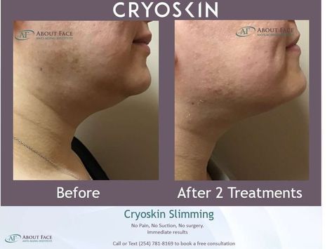 Cryoskin Facial: How It Works & What Are Its Benefits Facial Before And After, Microneedling With Prp, B12 Shots, Facial Benefits, Dilated Pores, Steaming Your Face, Slow Aging, Anti Aging Face, Anti Aging Treatments