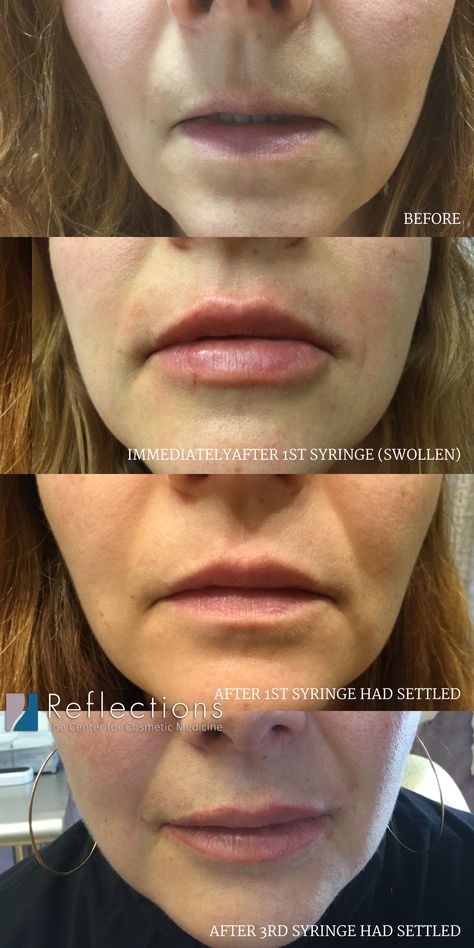 Multiple syringes of lip filler requires time to build up, especially when you want to change the lip shape. All 3 syringes were Juvederm, injected by Dr. Mitchell Chasin at Reflections Center in New Jersey. One Syringe Of Juvederm Lips, 2 Syringes Of Lip Filler, .5ml Lip Filler, Restylane Lyft, 1.5 Ml Lip Filler, .5 Syringe Lip Filler, Hyaluronic Acid Fillers, Eyebrow Lift, Botox Cosmetic