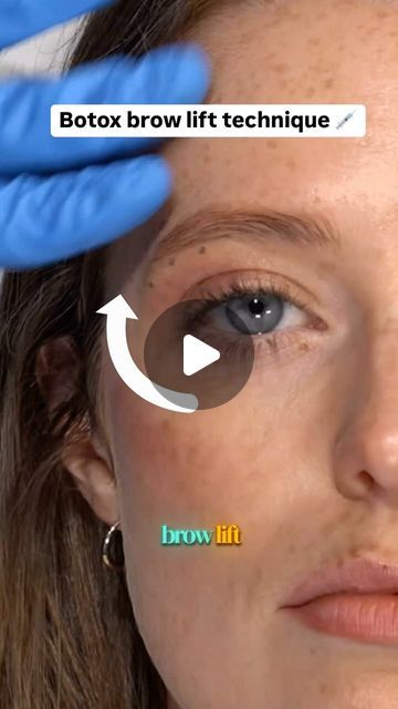 Dr Tim Pearce on Instagram: "Achieving a natural, lifted brow with targeted Botox injections. Watch the detailed steps for optimal results.

There’s still time to register for my free advanced Botox webinar on the 3rd of October, just comment TOX for the details." Brow Lift Botox Eyebrows, Botox Brow Lift, Botox Injections, Brow Lift, Beauty Ideas, Eyebrows, Beauty, Instagram