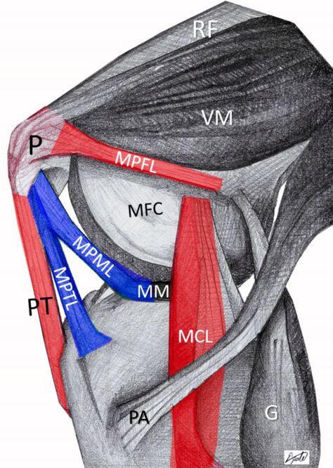 The-triangular-space-of-patellofemoral-dislocation-(red).-Patellar-dislocation-initiates-with-MPTL/MPML-rupture-(blue) Knee Mri, Avulsion Fracture, Human Knee, Anterior Cruciate Ligament, Case Presentation, Cruciate Ligament, Female Athlete, Magnetic Resonance Imaging, Magnetic Resonance