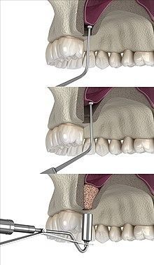 A sinus lift or a sinus augmentation or sinus graft; is performed by Oral and Maxillofacial surgeons. It's suitable for patients who want dental implants for missing teeth, but do not have adequate bone to secure implants. Read this interesting blog for more details. https://royalimplant.com/blogs/all-you-need-to-know-about-sinus-lift/ Maxillary Sinus, Bone Grafting, Missing Teeth, Healthy Bones, Dental Implants, Dental Clinic, Surgery, Need To Know, Quick Saves