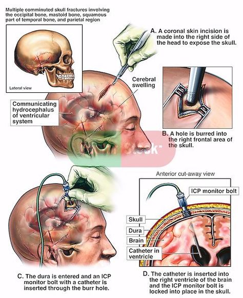 Intracranial Pressure, Surgical Nursing, Surgical Tech, Brain Anatomy, Critical Care Nursing, Medical School Studying, Brain Surgery, Medical Anatomy, Nursing Education