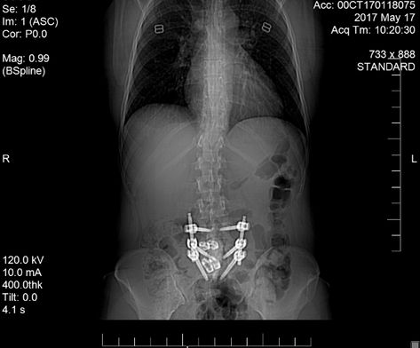 Spinal Fusion FAQ: What is the Average Spinal Fusion Recovery Time? | Mommy Runs It Lumbar Surgery Recovery, Spinal Fusion Surgery Recovery, Lumbar Vertebrae, Spinal Fusion Surgery, Spinal Fusion, Activities Of Daily Living, Spine Surgery, Surgery Recovery, Spinal Cord