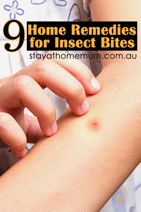 If you are one of those people that insects love to bite, here's some great home remedies to try! Bug Bite Swelling, Remedies For Bug Bites, Mosquito Bite Itch, Witch Hazel Acne, Itchy Bug Bites, Bug Bites Remedies, Bug Bite Relief, Bite Relief, Insect Bite