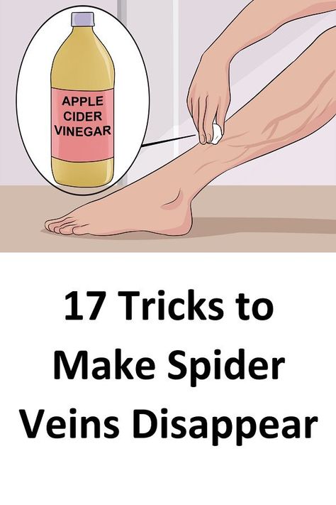 Spider Vein Remedies, Vericous Veins, Get Rid Of Spiders, Varicose Vein Remedy, Vein Removal, Natural Skin Care Remedies, Skin Natural Remedies, Natural Cough Remedies, Lose 40 Pounds