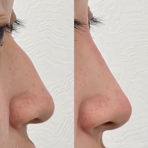 Nose filler, also known as non-surgical rhinoplasty, is a quick and effective procedure to smooth out bumps and straighten the bridge of the nose without the need for surgery. Just take a look at these incredible results! 💫 With just a few strategic and precise injections, Dr. Brock can sculpt your nose to achieve a smoother, more symmetrical profile from every angle. If you're searching to enhance your facial harmony or boost your confidence, nose filler can help you achieve the look you... Facial Harmony, Nose Filler, Nose Fillers, Nose Jobs, Granville Street, Curved Nose, Bent Nose, Flat Nose, Nose Job