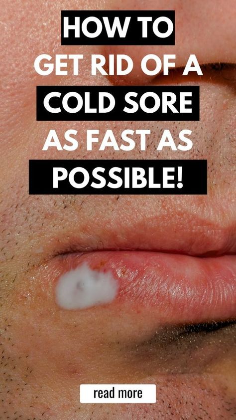 Learn how to get rid of a cold sore with these tried-and-true cold sore remedies and cold sore prevention tips. Discover the most common cold sore causes and triggers, natural remedies, over-the-counter medicines, and essential oils to help you prevent and manage cold sore outbreaks. Tap here for more tips and insights from a lifelong cold sore sufferer! #coldsore #remedies Coldsore Remedies Quick How To Get Rid, How To Get Rid Of A Cold Sore Overnight, Remedies For Cold Sore, Best Cold Sore Remedy Overnight, Coldsore Remedies Quick Cold Sore, Cold Sore Remedy Overnight How To Get Rid, Natural Remedies For Cold Sores, Cold Sores Remedies Overnight, Diy Cold Sore Remedy Fast