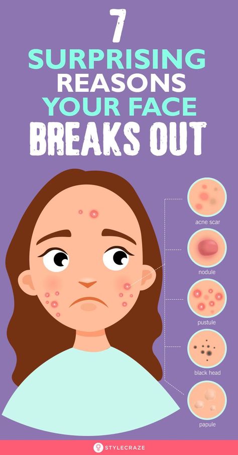 #Acne #Breakouts #SkinCare 7 surprising reasons why you're breaking out - from stress to hormones to the wrong skincare products. Learn how to get clear Face Breaking Out, Acne Reasons, Blind Pimple, Pimples Under The Skin, Pimples Remedies, Pimples On Face, Face Mapping, Types Of Acne, How To Get Rid Of Pimples