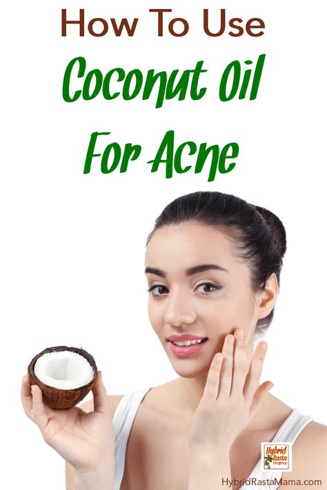 Do you know how to use coconut oil for acne? Hybrid Rasta Mama not only shares her insider tips for getting rid of acne fast but she also shows you have to make an awesome face wash to get rid of and prevent acne. #coconutoil #acne #acnetreatment #coconutoilandacne Treat Hormonal Acne, Lotion Coconut, Coconut Oil Lotion, Coconut Oil For Acne, Diy Coconut Oil, Diy Coconut, Acne Overnight, Benefits Of Coconut, Oil For Skin